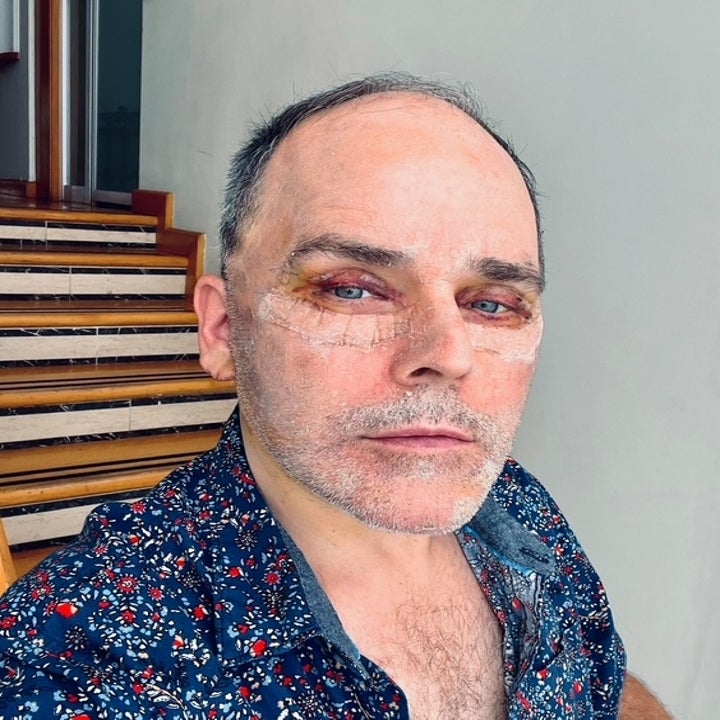 Jeg vet ikke hvem denne personen er. Personen har ansiktsskader og har på seg en mønstret skjorte, står foran trappene