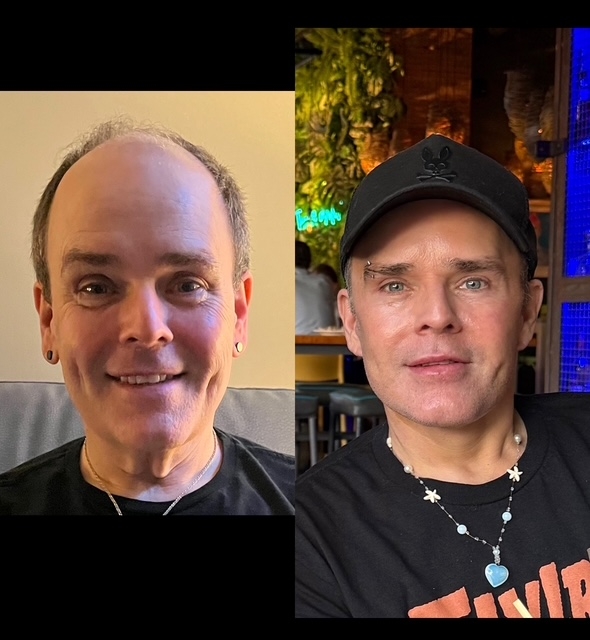 To nærbilder av side om side av en person som smiler, før og etter å ha mottatt kosmetiske forbedringer