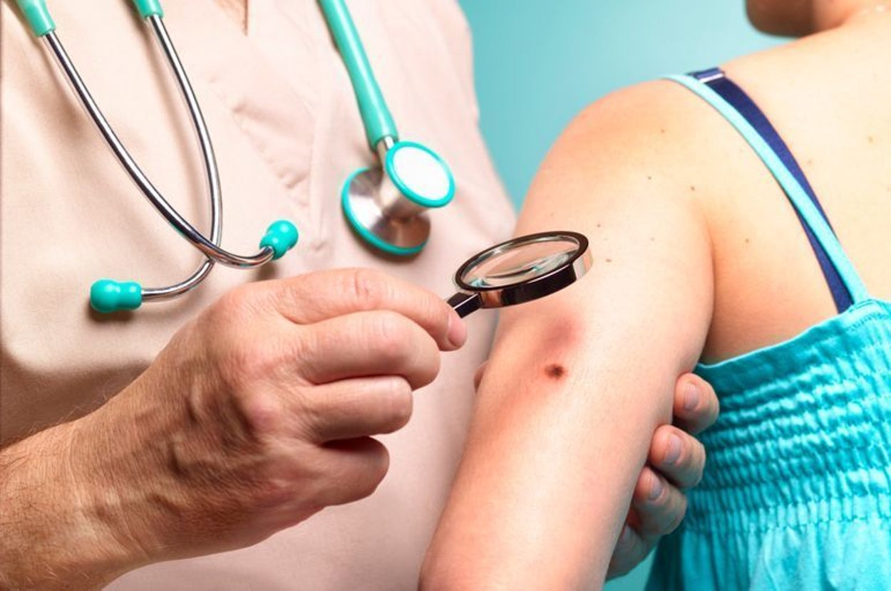 Endrer føflekken din? Det er på høy tid at du bestiller en avtale med hudlege