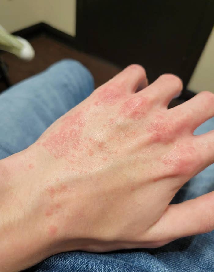 Synlig allergisk reaksjon på en persons hånd viser røde, irriterte flekker og støt på huden