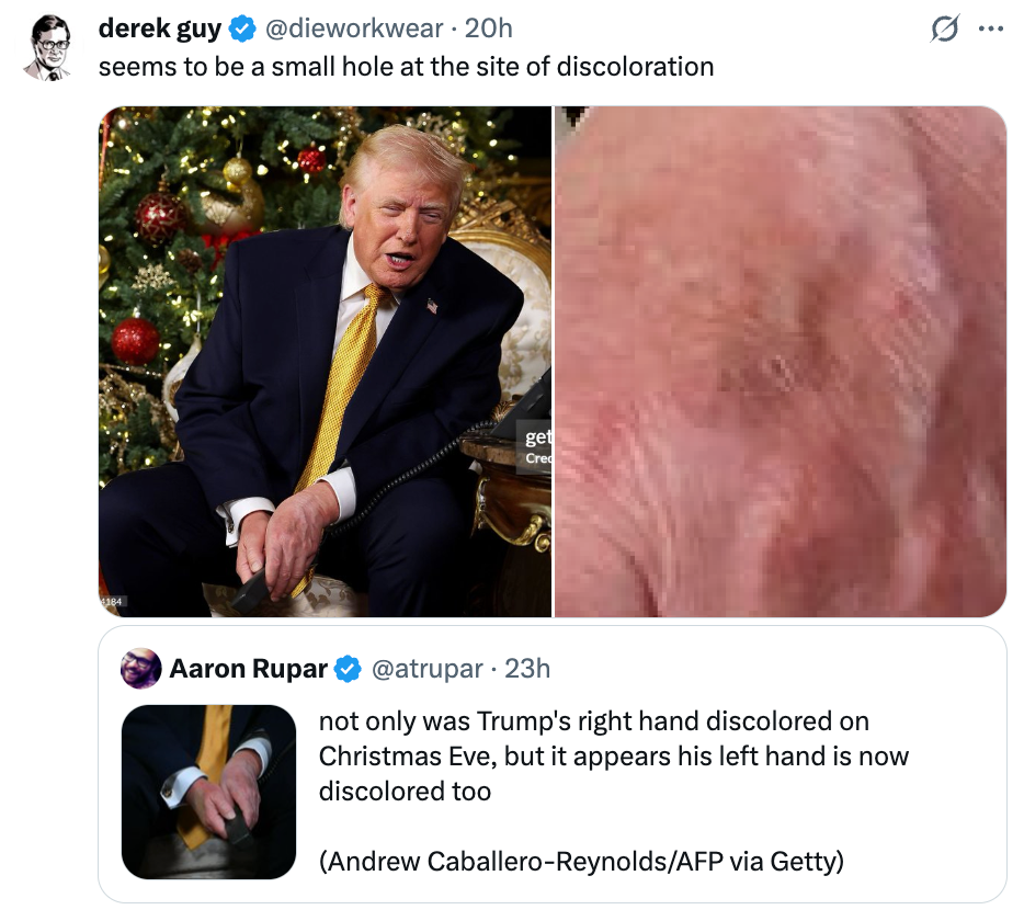To bilder av en offentlig person med håndmisfarging og kommentarer som diskuterer misfargingen som er synlig på begge bildene