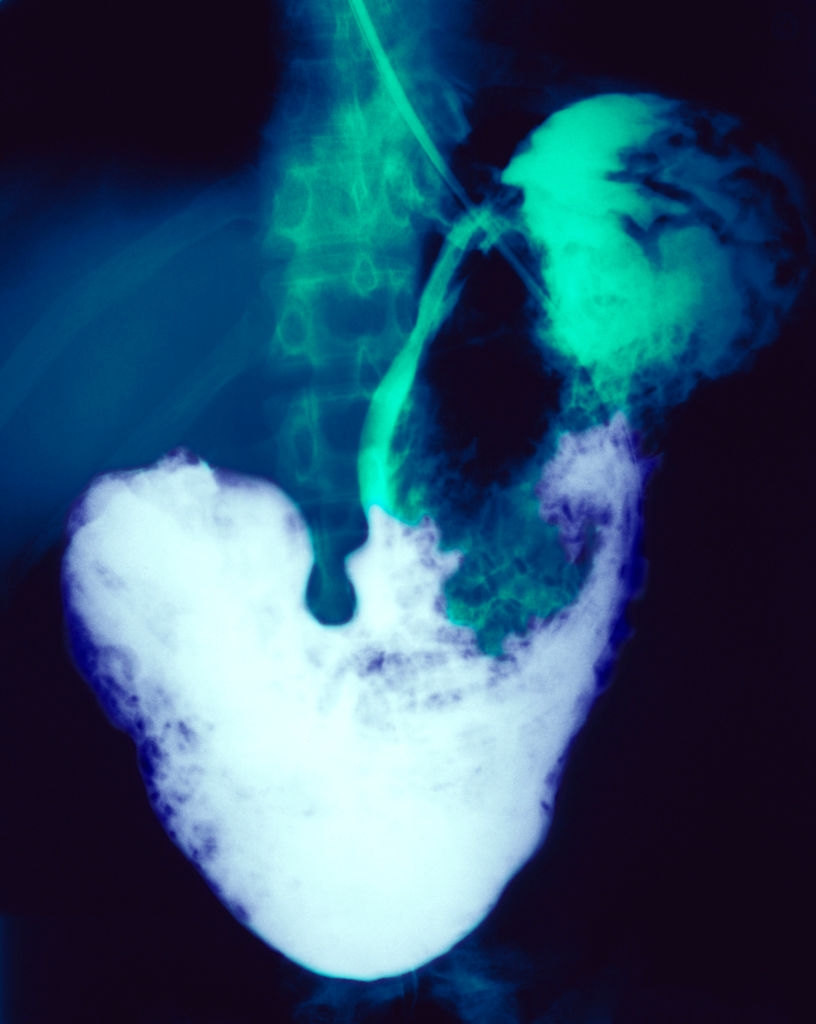 Medisinsk røntgenbilde som viser en bariumsvelgestudie av fordøyelseskanalen med kontrast som fremhever spiserøret og magen