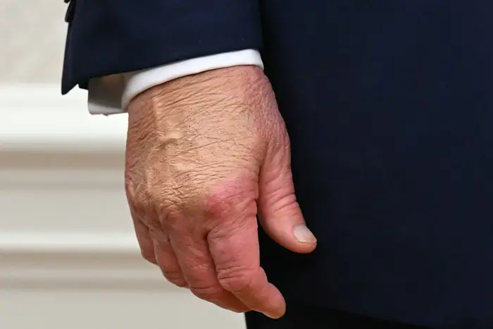 Nærbilde av Donald Trumps hånd dekket av sminke i en formell dress, noe som tyder på en offentlig opptreden eller begivenhet