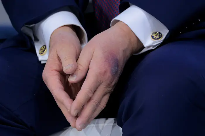 Hendene hviler på fanget, iført en dress med offisielle mansjettknapper. Den ene hånden viser et synlig blåmerke