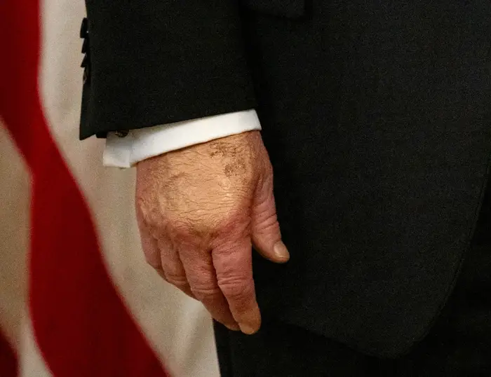 Donald Trump i formell dress med et mønstret slips, stående foran flaggbakgrunn; høyre hånd har sminke for å dekke blåmerkene